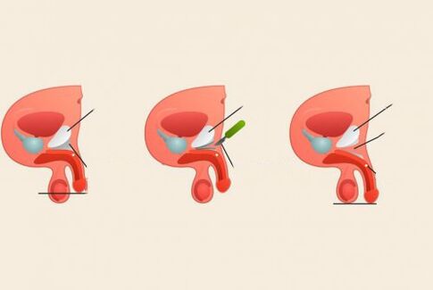 před a po operaci zvětšení penisu